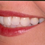 enhancements for a natural smile - a must at Dr A's